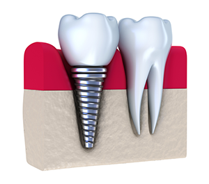 Dental Implants Dentist | In South Berwick, ME | South Berwick Dental